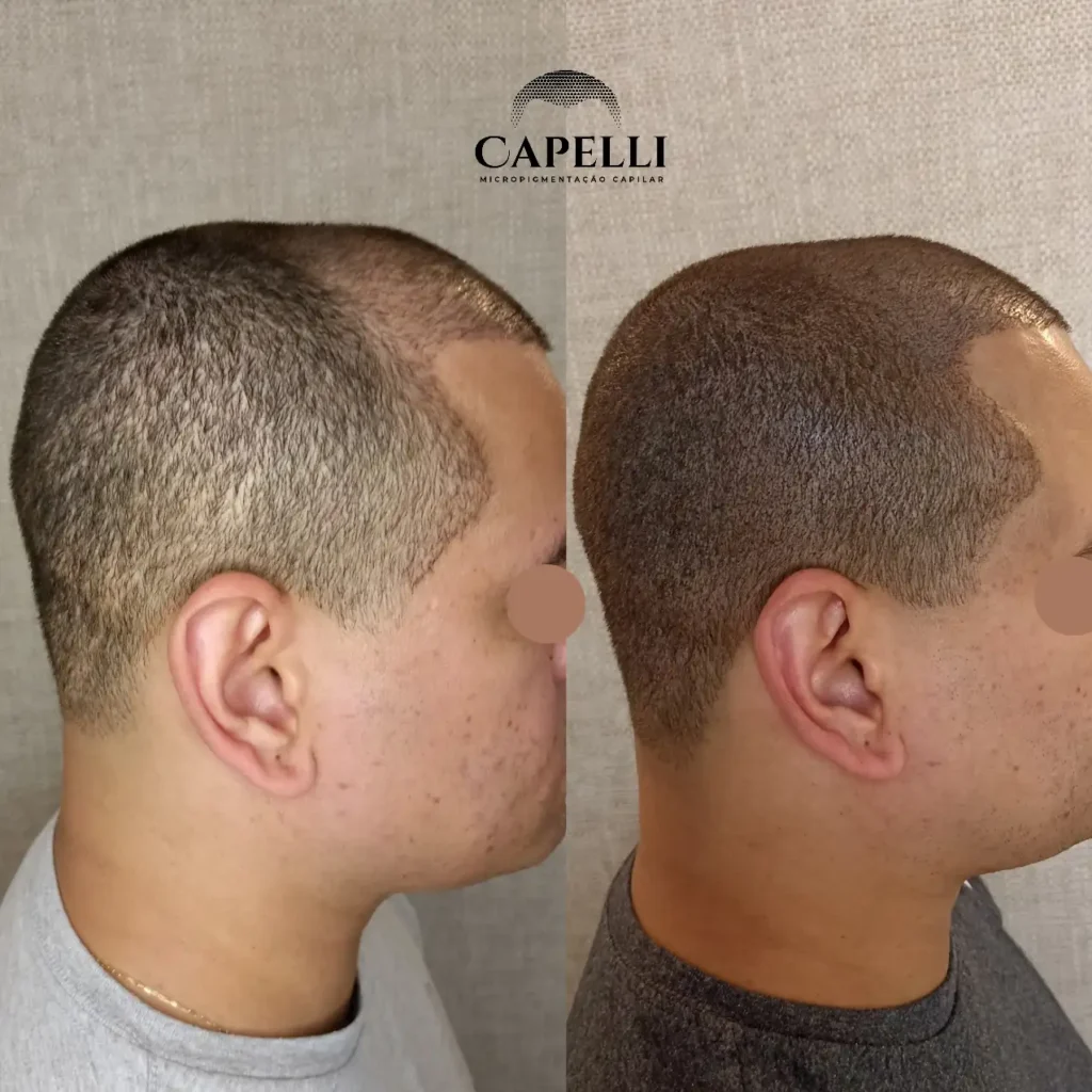 Cobertura de Cicatrizes de Transplante Capilar com Micropigmentação em Brasília